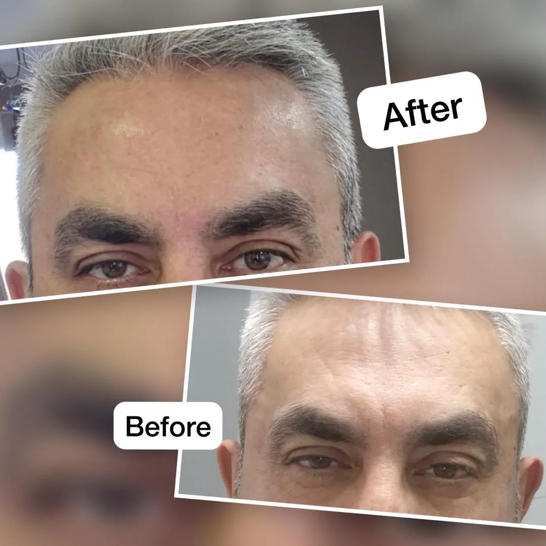 بوتاکس
