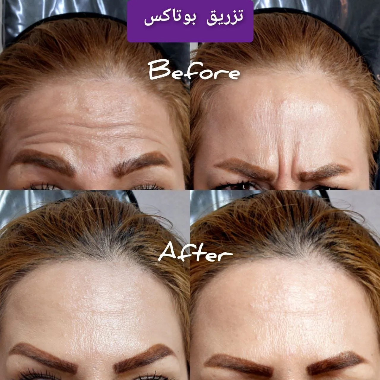 بوتاکس