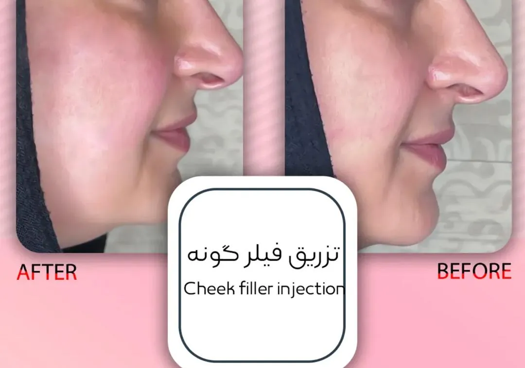 تزریق فیلر گونه
