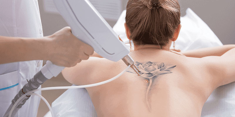 پاک کردن تاتو