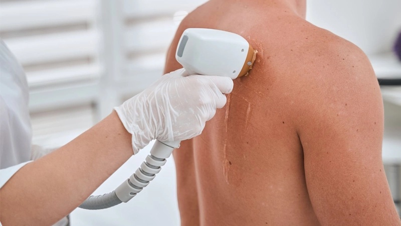 لیزر موهای زائد